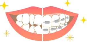 歯並びがガタガタになる原因は　矯正