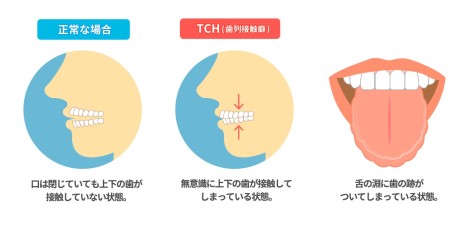 食いしばり(TCH)と矯正治療