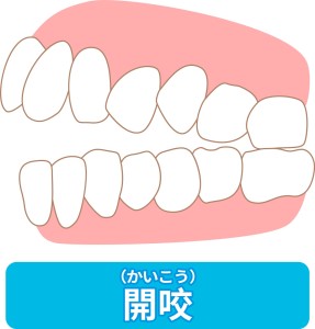 出っ歯　矯正　メリット