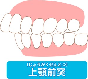 矯正　歯を抜かない　抜歯　非抜歯