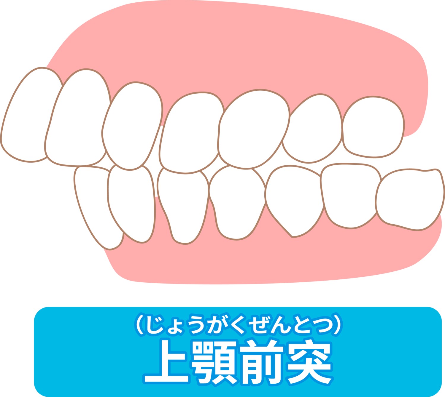 矯正　歯を抜かない　抜歯　非抜歯