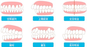 矯正治療とEライン