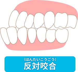 骨格の問題　矯正　外科　受け口