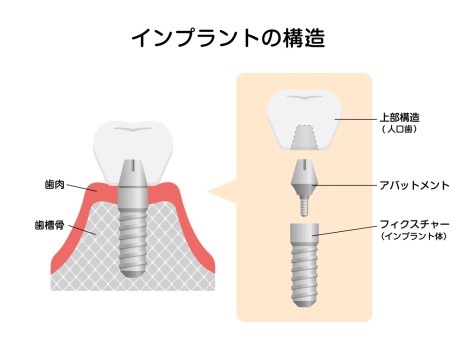 差し歯　インプラント　矯正　できる　できない　歯列矯正　