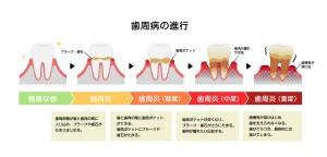 前歯　痛み　原因　矯正