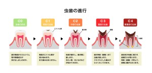 前歯　痛み　原因　矯正