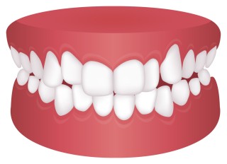 歯列矯正　歯科矯正　矯正治療　必要性　歯並び　チェック