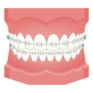 歯並びがガタガタになる原因は　矯正