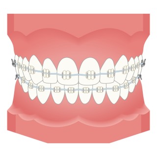 矯正中　口臭　対策　対処法　口腔ケア