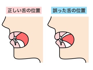 矯正後の保定