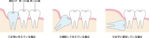 前歯　痛み　原因　矯正