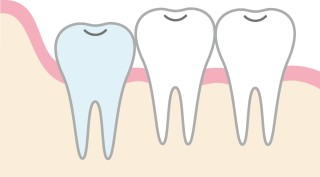 親知らず　矯正　関係　抜歯