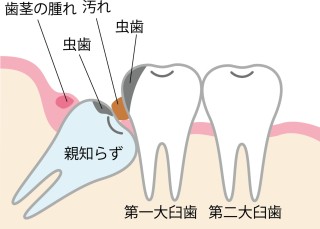 親知らず　矯正　関係　抜歯