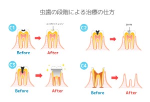 前歯　痛み　原因　矯正