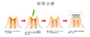 前歯　痛み　原因　矯正