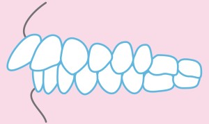 出っ歯　矯正治療　保険適用