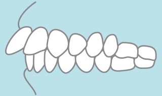 歯並び　改善　矯正治療　メリット　デメリット　
