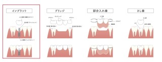 セラミックやインプラントがある方必見！矯正治療はできるの？