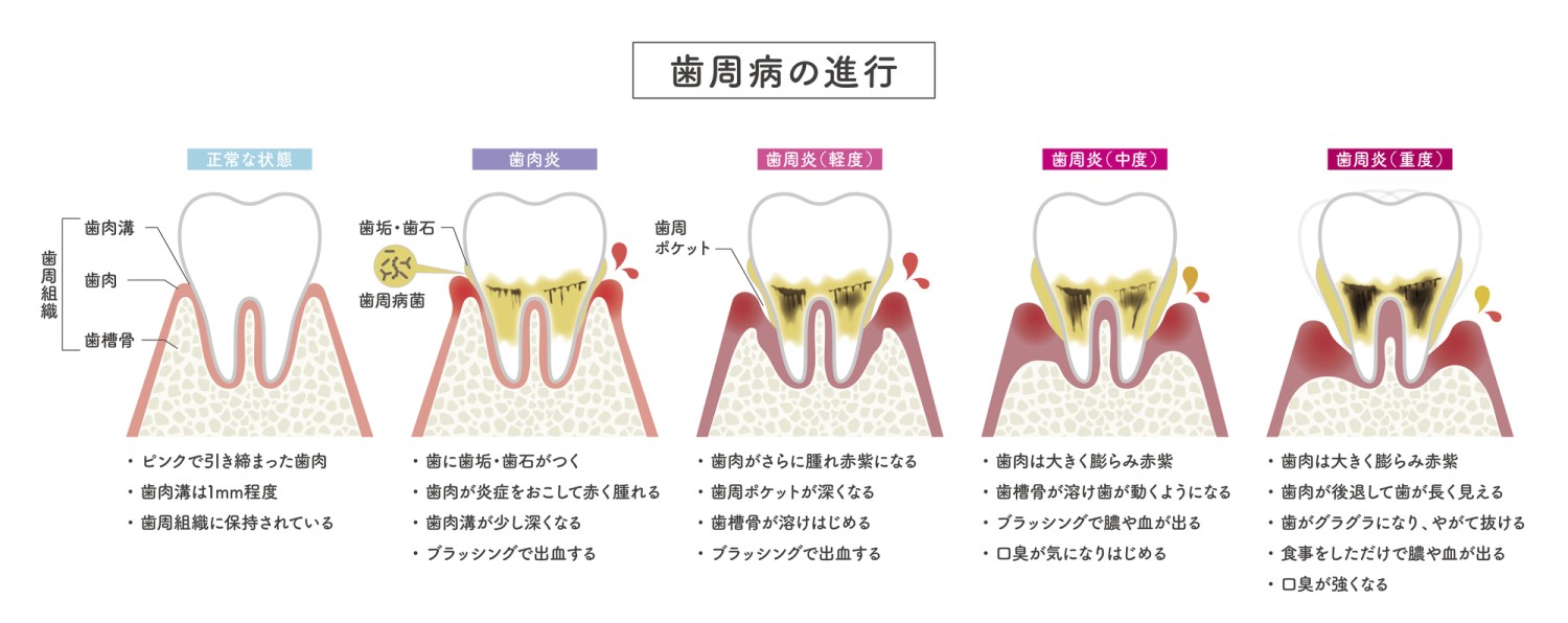 歯並び変化 歯の速度 影響 歯周病