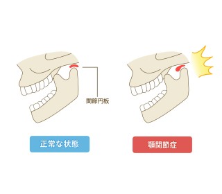 かみ合わせ　チェックリスト　矯正　改善