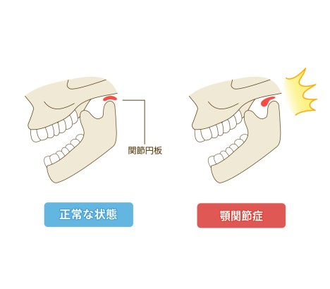 顎関節症　歯科矯正　歯列矯正　