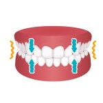 食いしばり（TCH）と矯正治療