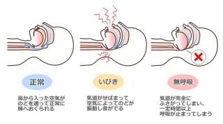 MSE矯正 歯を抜かない矯正　睡眠時無呼吸症候群