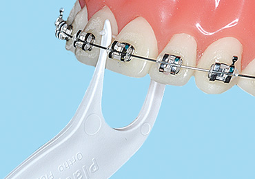歯列矯正　矯正治療　デンタルフロス　プラティパス