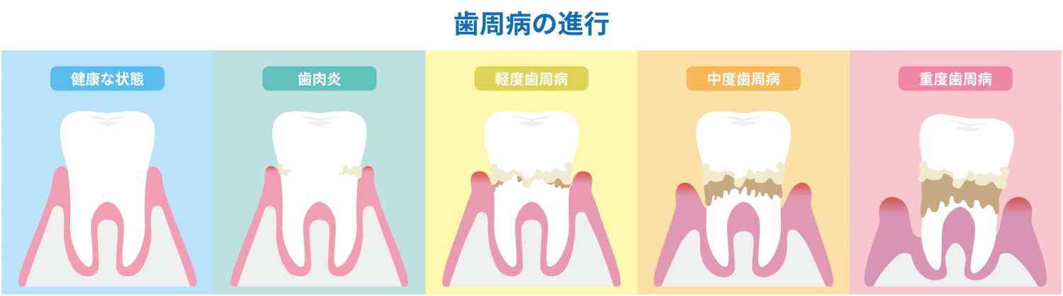 不正咬合 噛み合わせ 歯周病 リスク