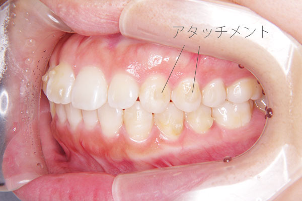 アタッチメント