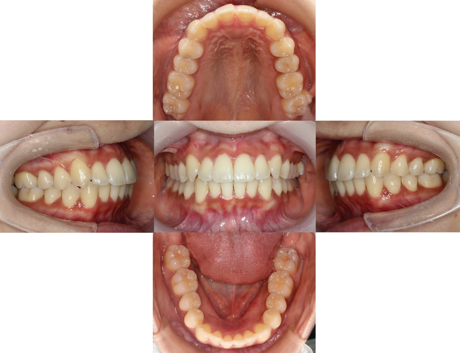 八重歯・裏側矯正の症例