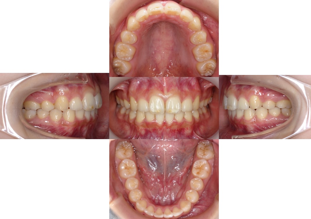 上顎前突・裏側矯正
