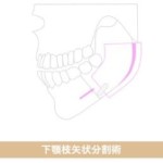 下顎矢状分割骨切り術