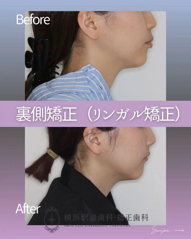 .
.
〚叢生の改善🦷✨〛

＊20代/女性

＊主訴→上の歯が出ている、口が閉じにくい

＊診断名→上顎前歯の唇側傾斜を伴う骨格性Ⅱ級叢生症例

＊治療期間→2年2ヶ月

＊使用装置
→ｾﾙﾌﾗｲｹﾞｰｼｮﾝﾌﾞﾗｹｯﾄ装置（ｸﾘｯﾋﾟｰL）,歯科矯正用ｱﾝｶｰｽｸﾘｭｰ,ﾏｳｽﾋﾟｰｽ型矯正装置（ｲﾝﾋﾞｻﾞﾗｲﾝ）

＊抜歯部位
→上顎両側第一小臼歯

＊費用
→1,320,000円（税込）　

﹏﹏﹏﹏﹏﹏﹏﹏
ご自身がどんな治療ケースに当てはまるかは、無料カウンセリング+精密検査で把握することができます🔅

まずは無料カウンセリングにてご相談ください🌱

🌼ご予約方法
24hネット予約可能🖥
プロフィール欄に記載のURLよりご覧ください✮

お電話はこちら☎
0120-418-139

🌼クリニック
横浜駅西口徒歩3分

#矯正歯科
#矯正治療
#裏側矯正
#横浜駅前歯科矯正歯科
#渋谷矯正歯科グループ
#歯列矯正記録