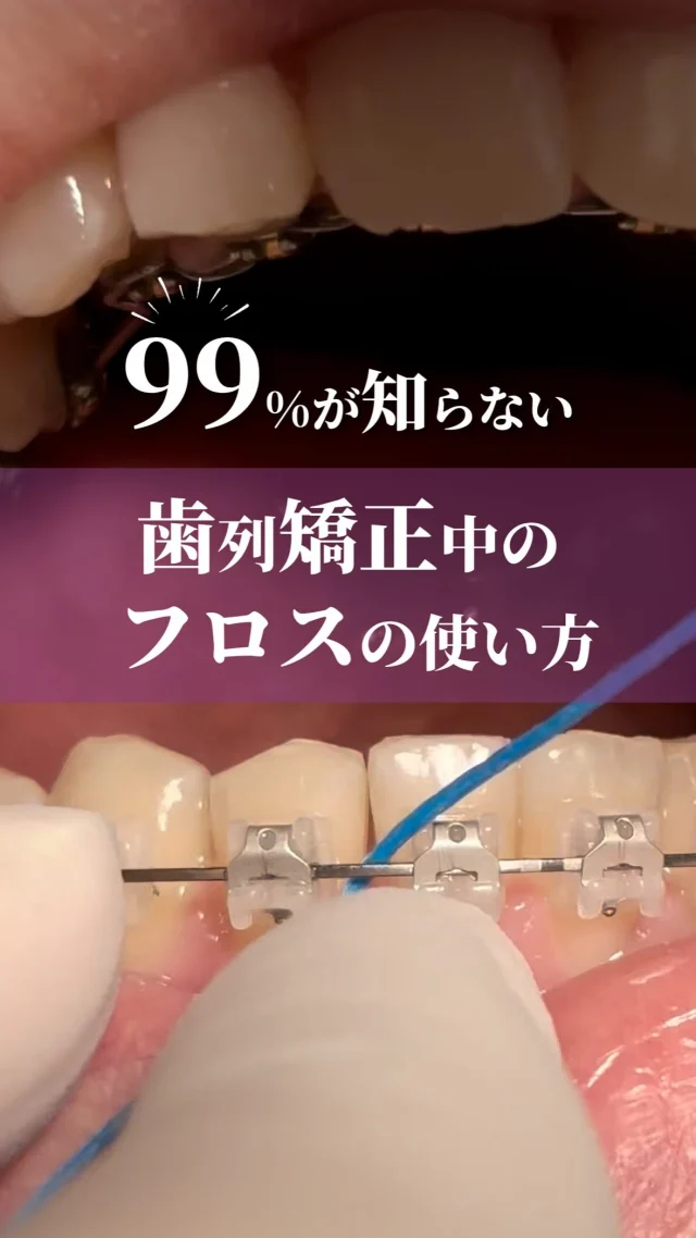 フロスを使う大きな目的はプラーク（歯垢）の除去です。
プラークは細菌の塊で、虫歯や歯周病の原因となります🦠
歯の横の面やポケット内のプラークを除去するためには、フロスでこすりとる必要があります。
フロスを入れて抜くだけでは、挟まっていた食べ物が取れるだけです。
一生自分の歯で食事をたのしむには、毎日正しくフロスを使用することが大切です。

ワイヤー矯正中にお勧めのフロアフロスセイビングは、青い部分が適度な硬さがあり、狭い隙間にスッと通せます。
白いフロス部分は、大人気のフロアフロスと同じく384本の繊維でできており、優しくごっそりプラークをかきだします。
ワイヤー矯正中の方だけではなく、ブリッジやインプラントが入っている方にもおすすめです！

ーーーーーーーーーーーーー
@yokohama_kyouseishika 
↑こちらのアカウントでは
▶︎症例写真（歯列矯正のビフォーアフター）
▶︎歯や矯正に関する知識・情報
▶︎クリニックの雰囲気
などをお届けしています。
ーーーーーーーーーーーーー 横浜駅前歯科・矯正歯科は横浜駅から徒歩3分
▶世界舌側矯正歯科学会認定医
▶ヨーロッパ舌側矯正歯科学会認定医
▶日本成人矯正歯科学会認定矯正歯科衛生士
▶︎日本歯科医師振興機構 臨床歯科麻酔管理指導医 /臨床歯科麻酔認定歯科衛生士
▶︎日本アンチエイジング歯科学会 ホワイトニングエキスパート
が在籍しています。

歯並び ・噛み合わせの無料カウンセリング は、こちらのプロフィール　@yokohama_kyouseishika 記載のURLからご予約お願いいたします。

#横浜矯正歯科#フロス#認定医#ハーフリンガル#認定矯正歯科衛生士