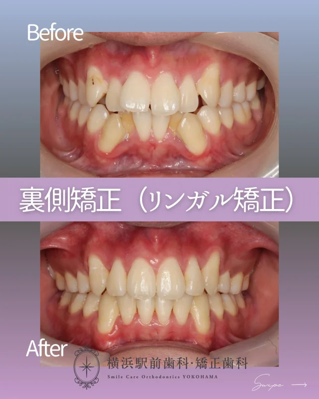 .
.
〚叢生の改善🦷✨〛

＊10代/男性

＊主訴→上下前歯のガタガタ

＊診断名→骨格性Ⅰ級AngleⅠ級叢生症例

＊治療期間→1年2ヶ月

＊使用装置
→ﾏﾙﾁﾌﾞﾗｹｯﾄ装置（ｸﾘｯﾋﾟｰC）ｾﾙﾌﾗｲｹﾞｰｼｮﾝﾌﾞﾗｹｯﾄ装置（ｸﾘｯﾋﾟｰL）,歯科矯正用ｱﾝｶｰｽｸﾘｭｰ

＊抜歯部位
→上下顎両側第一小臼歯

＊費用
→1,265,000円（税込）　

﹏﹏﹏﹏﹏﹏﹏﹏
ご自身がどんな治療ケースに当てはまるかは、無料カウンセリング+精密検査で把握することができます🔅

まずは無料カウンセリングにてご相談ください🌱

🌼ご予約方法
24hネット予約可能🖥
プロフィール欄に記載のURLよりご覧ください✮

お電話はこちら☎
0120-418-139

🌼クリニック
横浜駅西口徒歩3分

#矯正歯科
#矯正治療
#裏側矯正
#横浜駅前歯科矯正歯科
#渋谷矯正歯科グループ