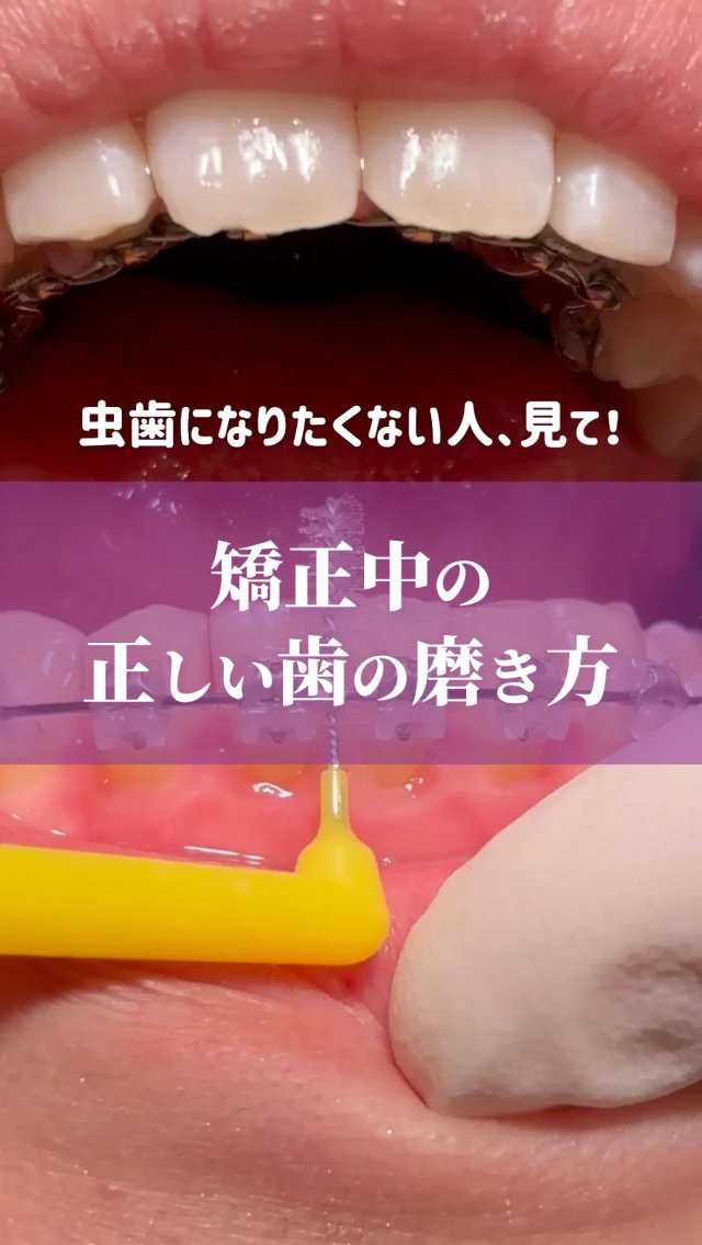 オススメのケア用品はこちら🔻

①フロアフロスセイビング
青い部分は適度な硬さがあるので、ワイヤー下に通しやすいです。大人気のフロアフロスと同じ384本の繊維が汚れを絡め取ります。
詳しいフロスの使い方は前回のリール動画『歯列矯正中のフロスの使い方』をご覧ください。

②ワンタフトシステマshort
柔らかい毛で、矯正中の痛みがあるときでも優しく磨けます。毛の長さが10㎜と長めなので、裏側矯正の届きにくい部位にも使いやすいです。

③P.Grip矯正専用四段植毛M
超極細毛とラウンド毛の密度の高い山型ヘッドで、アーチワイヤーやフックの下など、矯正装置の周りを効果的に清掃できます。

歯ブラシは患者さんの口腔内の状態や装置の種類により、おすすめするものは変わってきます。
歯ブラシ選びでお困りの方は、ぜひ歯磨きのプロ・歯科衛生士にお尋ねください👩‍⚕️

※歯間ブラシのサイズは、表側矯正はS、裏側矯正は4Sをおすすめしています。

ーーーーーーーーーーーーー
@yokohama_kyouseishika
↑こちらのアカウントでは
▶︎症例写真
▶︎歯や矯正に関する知識・情報
▶︎クリニックの雰囲気
などをお届けしています。
ーーーーーーーーーーーーー 
歯列矯正の無料相談は、こちらのプロフィール　@yokohama_kyouseishika 記載のURLからご予約お願いいたします。

#歯列矯正中#歯科衛生士が教える#歯磨き方法#ハーフリンガル#裏側矯正