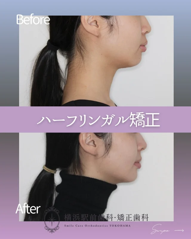 .
.
〚出っ歯の改善🦷✨〛

＊20代/女性

＊主訴→上の歯が出ている、下のガタガタ

＊診断名→上顎前歯唇側傾斜および過蓋咬合を伴うAngleⅡ級叢生症例

＊治療期間→3年1ヶ月

＊使用装置
→ﾏﾙﾁﾌﾞﾗｹｯﾄ装置（ｸﾘｯﾋﾟｰC）,ﾏｳｽﾋﾟｰｽ型矯正装置（ｷｭｱｱﾗｲﾅｰ）,ｾﾙﾌﾗｲｹﾞｰｼｮﾝﾌﾞﾗｹｯﾄ装置（ｸﾘｯﾋﾟｰL）,歯科矯正用ｱﾝｶｰｽｸﾘｭｰ

＊抜歯部位
→上顎両側第一小臼歯

＊費用
→1,21,000円（税込）　

﹏﹏﹏﹏﹏﹏﹏﹏
ご自身がどんな治療ケースに当てはまるかは、無料カウンセリング+精密検査で把握することができます🔅

まずは無料カウンセリングにてご相談ください🌱

🌼ご予約方法
24hネット予約可能🖥
プロフィール欄に記載のURLよりご覧ください✮

📍アクセス
横浜駅西口徒歩3分

#矯正歯科
#矯正治療
#ハーフリンガル矯正
#横浜駅前歯科矯正歯科
#渋谷矯正歯科グループ