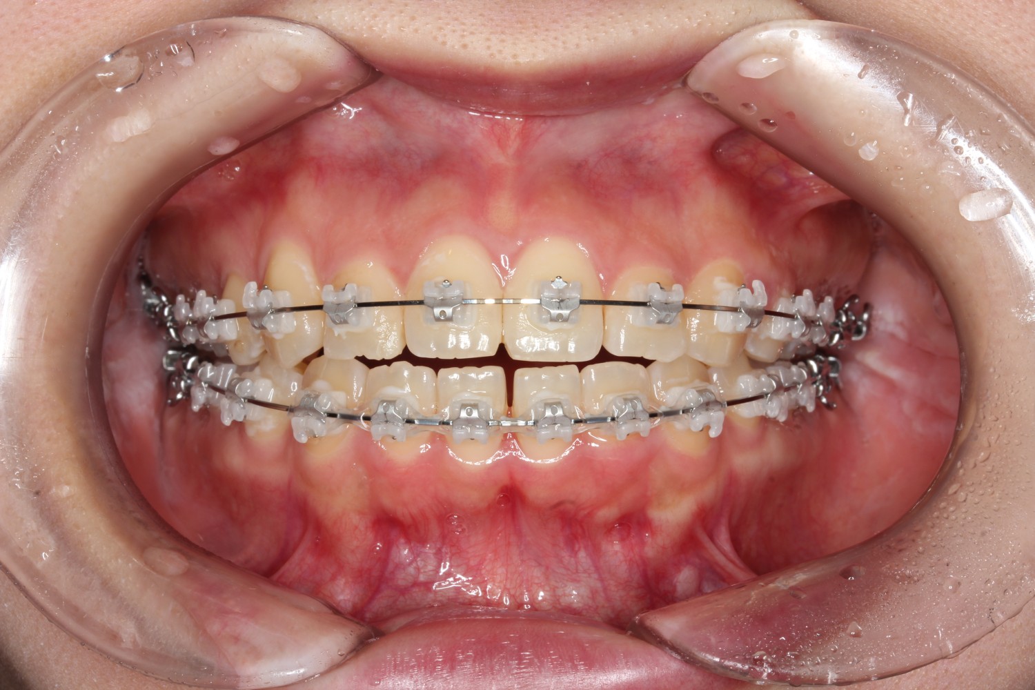 矯正装置　目立たない　矯正治療　表側矯正　ラビアル矯正　クリッピーC　メタルワイヤー　