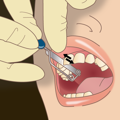 マウスピース矯正　ディスキング　IPR　