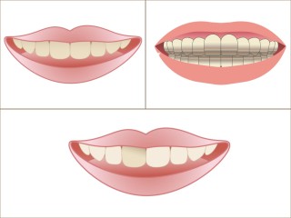 歯の変色　歯のホワイトニング　テトラサイクリン歯