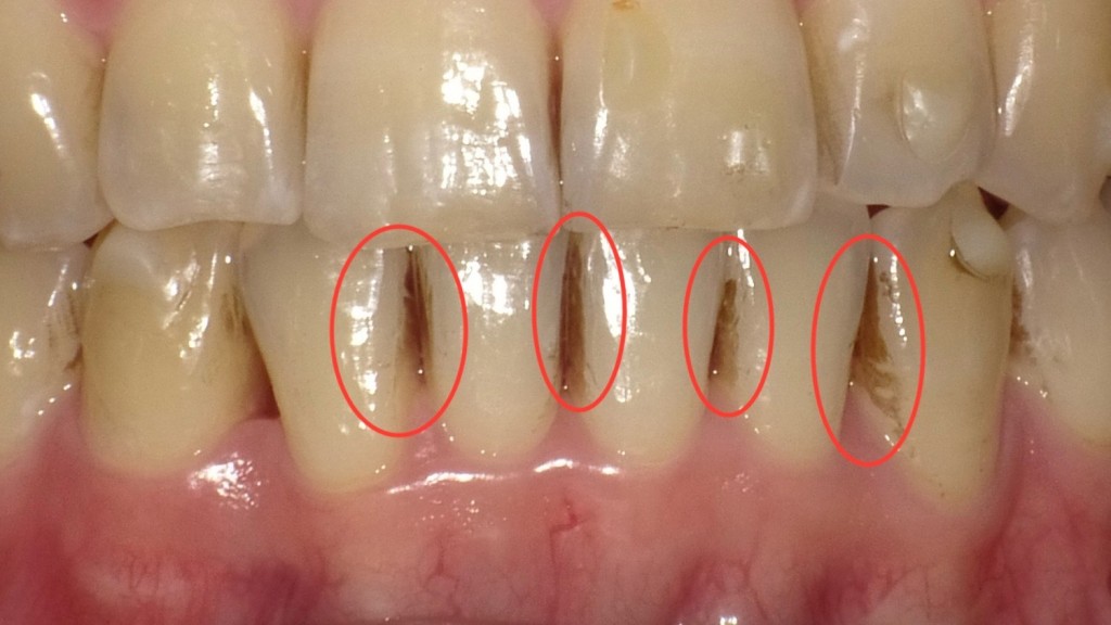 歯が着色しやすい　歯の着色　歯の着色汚れ