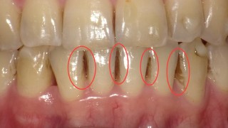 歯が着色しやすい　歯の着色　歯の着色汚れ