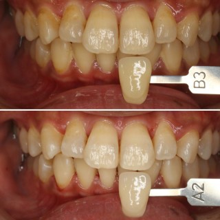 歯医者さんのホワイトニング