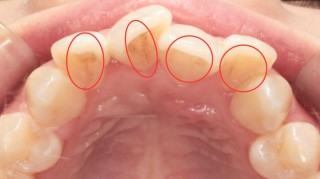 歯が着色しやすい　歯の着色汚れ　歯並び悪い