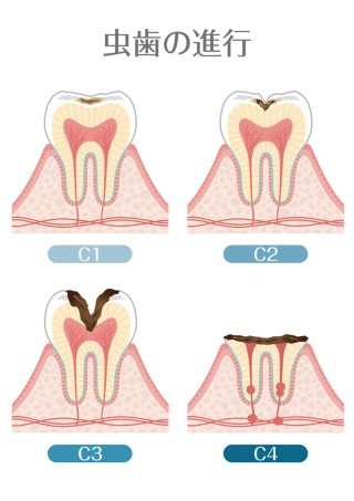虫歯　抜歯　歯並び