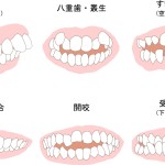 不正咬合　噛み合わせ　リスク