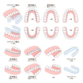 矯正装置　目立たない　矯正治療　