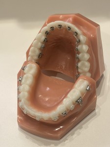 出っ歯　矯正治療　保険適用