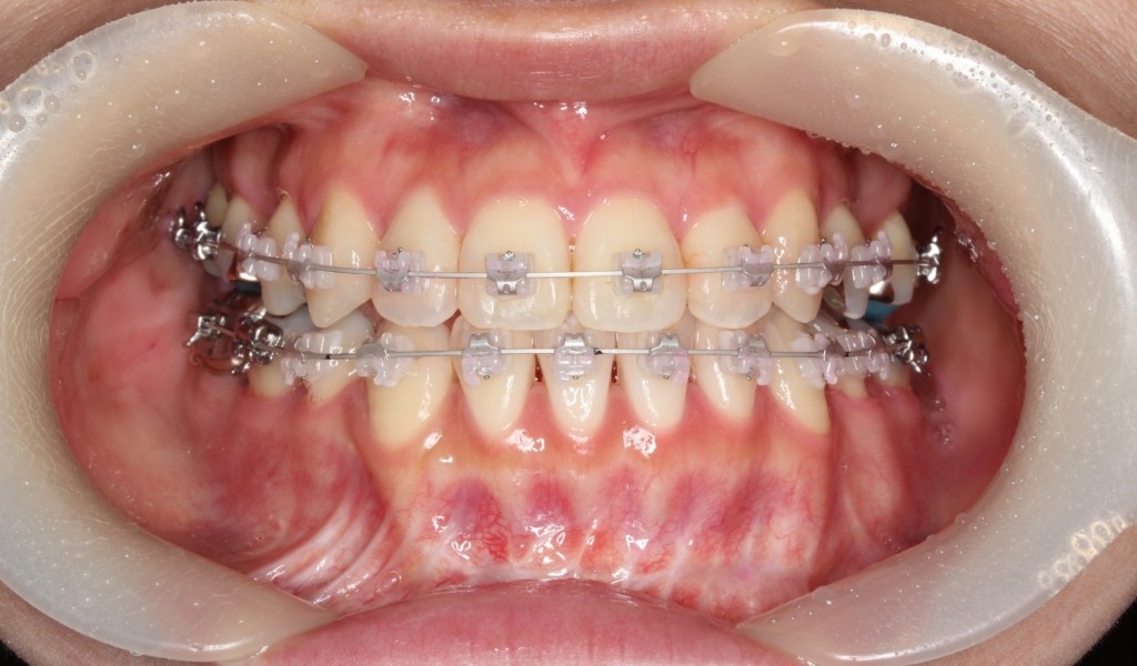 矯正装置　目立たない　矯正治療　表側矯正　ラビアル矯正　クリッピーC　ホワイトワイヤー